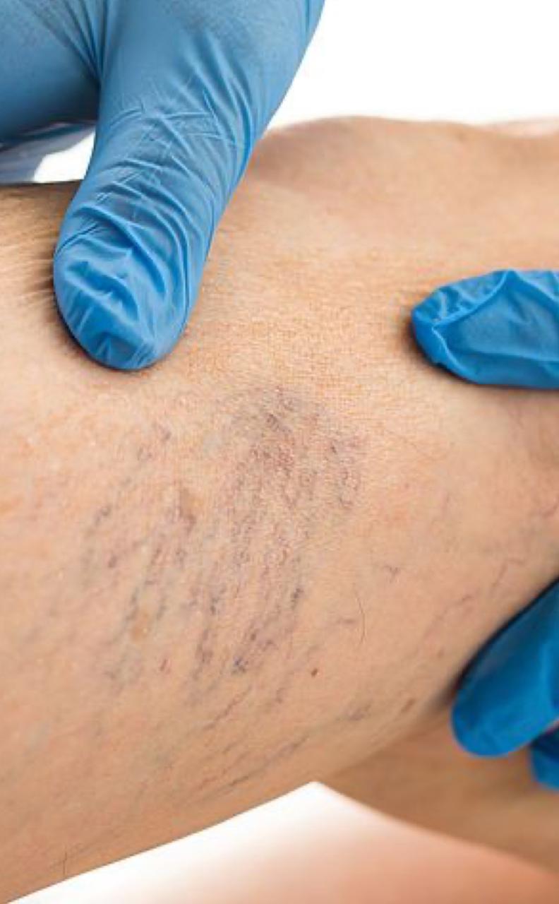 El Plasma Láser para arañitas